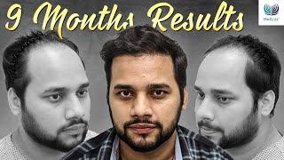 Astonishing 9 Months Results  Before and After Hair Transplant  Medlinks Delhi [upl. by Ebba]