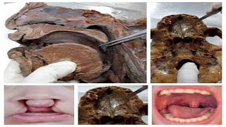 Anatomy Dissection of Hard and Soft Palate [upl. by Tory977]