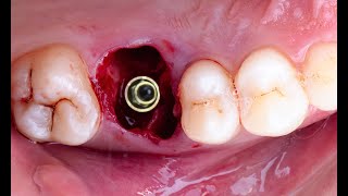 immediate implant placement in the molar area [upl. by Pearlstein]