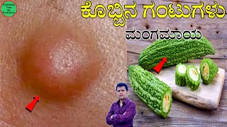 Lipoma Ayurvedic Treatment  lipoma mane maddu  lipoma ayurvedic treatment kannada  kobbina gantu [upl. by Ennirac]