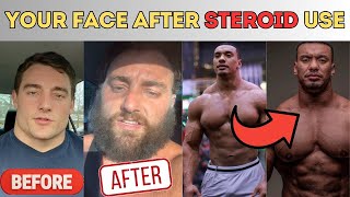 How you look AFTER steroids What steroids does to your face [upl. by Eixel245]