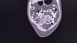 Mesenteric haematoma spontaneous  CT findings [upl. by Timon]