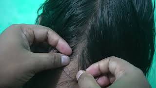 Lice Infested Catching and Popping Sounds  ASMR Lice Picking In My Head [upl. by Niar]