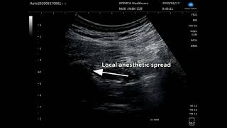 Modified subcostal QL block for postoperative analgesia  Supplementary video 2 ID 306696 [upl. by Meean]