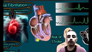 Atrial Fibrillation  The most common arrythmia Causes symptoms treatment [upl. by Nnovahs]