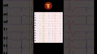 shorts ECG case from FOXTERRIER 5 [upl. by Anastasius]