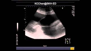 Sclerosing Encapsulating Peritonitis [upl. by Trumann108]