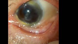 Ocular Cicatricial Pemphigoid [upl. by Pfeffer]