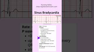 Sinus Bradycardia ECG EKG Nursing Treatment Rhythm Made Easy in Less Than 1 Minutes nursing ecg [upl. by Currie]