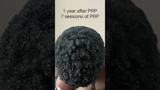 Prp hair results after a year ⚠️ [upl. by Lane780]