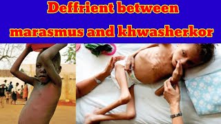 deffrient between marasmus and kwashiorkor  kwashiorkor vs marasmus pashto [upl. by Yddet]