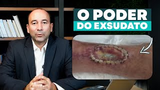 O poder do Exsudato tecnicadefigueiredo [upl. by Cosme]