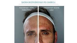 MEZOTERAPIA IGŁOWA VS MEZOTERAPIA WIELOIGŁOWA VITAL INJECTOR 2 [upl. by Ahsiekat]