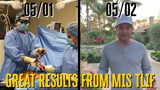 AMAZING RESULTS LESS THAN 24 HOURS AFTER A MIS TLIF Patient testimonial at the end of video [upl. by Wiersma]