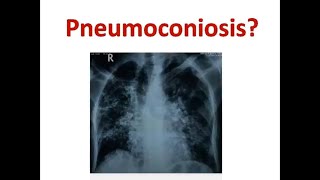 Pneumoconiosis on Chest XRay and CT Scan Chest [upl. by Eveivaneg]