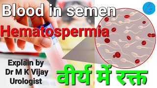 Blood in semen  Hematospermia causes diagnosis treatment in hindi [upl. by Becket]