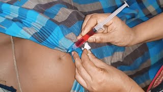 ivf buttock injection video Neuralgin Intramuscular injection buttock injection push 24 Ep 25 [upl. by Bobbe900]