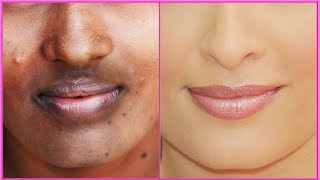 How To Remove Dark Black Patches Dark SpotsHyper Pigmentation Around Your Mouth  Uneven Skin Tone [upl. by Yenots934]