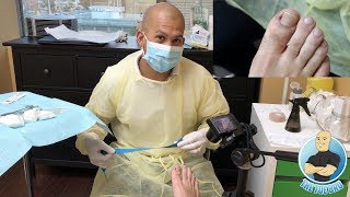 INGROWN TOENAIL SURGERY  How To Remove An Ingrown Toenail Forever POV [upl. by Ssenav]