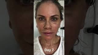 6 WEEK COMPLETE TRANSFORMATION DaybyDay Facelift Progression [upl. by Anoj]