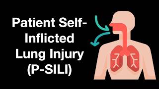 Patient Self Inflicted Lung Injury P SILI [upl. by Marigolda]