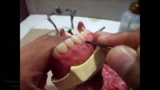 Festooning a Complete denture [upl. by Nodanrb]