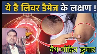 लीवर डैमेज का स्किन symptoms Acanthosis Nigricans Kya hota hai ये है लिवर डैमेज के लक्षणhealthtips [upl. by Ramad]