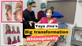 Big Transformation ni Yaya Jina Rhinoplasty  Blepharoplasty amp chin augmentation [upl. by Lamp]