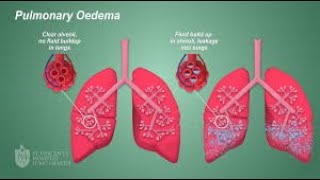 ACUTE PULMONARY EDEMA  signs and symptoms  Treatment of acute pulmonary edema [upl. by Joel]