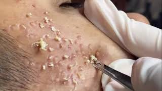 ACNE TREATMENT Video Remove inflammatory acne  April 20 2021 [upl. by Amiaj]