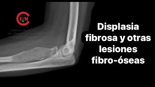 Displasia fibrosa y otras lesiones fibroóseas [upl. by Damha]