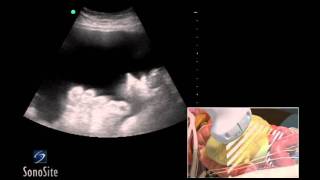 How To Ultrasound Guided Paracentesis Procedure 3D Video [upl. by Attenat]