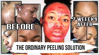 I LOOK LIKE THIS 7 WEEKS AFTER USING THE ORDINARY AHA 30  BHA 2 PEELING SOLUTION ♡OfficialTashika [upl. by Nedyah]