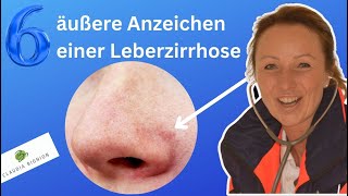 Leberzirrhose Erkenne die Symptome dieser schweren Lebererkrankung einfach erklärt [upl. by Attolrahc]