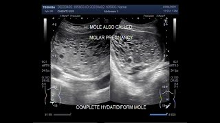 A case of complete Hydatidiform Mole [upl. by Ardnohs]