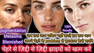 In 14 Days 😱Remove झाइयाँ melasma Pigmentation Dark Spots Naturally amp Get Clear Glowing Skin tips💞 [upl. by Henarat]