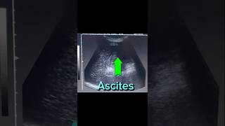 Ultrasound Ascites  Free Fluid  Abdomen Pelvic Ascites  Hepatic Parenchymal Disease [upl. by Tucker]