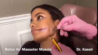 Botox for Masseter Muscle [upl. by Riccio5]