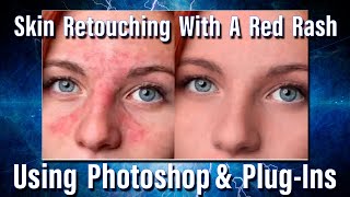 Retouching skin with a bad rash in Adobe Photoshop [upl. by Enilra]