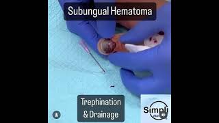 Subungual Hematoma Trephination [upl. by Nadabus]