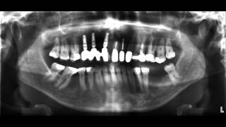 für Zahnärzte das OPTG Röntgen [upl. by Aro]