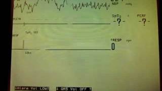 Asystole Apnea alarms [upl. by Yanahs389]