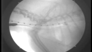 Primary Tracheal Collapse6DAY29Stent Placement under fluoroscopy [upl. by Ahsirahc]