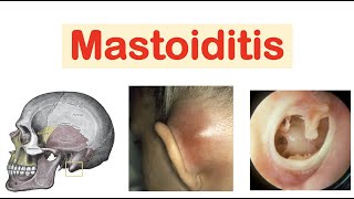 Mastoiditis amp Acute Otitis Media  Causes Pathophysiology Symptoms Diagnosis Treatment [upl. by Llewxam]