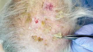 Debulking Lesions on the Scalp Erosive Pustulosis of the Scalp  CONTOUR DERMATOLOGY [upl. by Zilada]