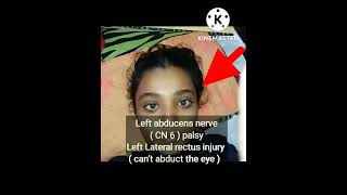 Left abducens nerve  CN 6  palsy [upl. by Zevahc828]