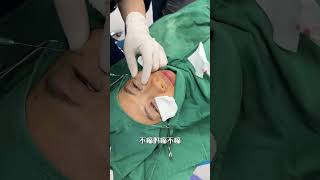 Eye bags disappear fyp facelift rhinoplasty plasticsurgeon 整形 [upl. by Eatnoj495]