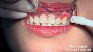 Gingival Depigmentation Gum Bleaching  Gum Lightening Treatment SIROLaser Blue [upl. by Yblek178]