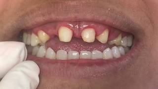 Houston Cosmetic DentistGaps missing teeth and an open biteWatch this makeover [upl. by Adlaremse751]