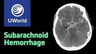 Subarachnoid Hemorrhage amp Treatment  nimodipine USMLE STEP 1 UWORLD Questions Nervous system [upl. by Nagrom154]